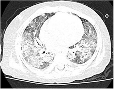 Pulmonary Alveolar Proteinosis Due to Pneumocystis carinii in Type 1 Hyper-IgM Syndrome: A Case Report